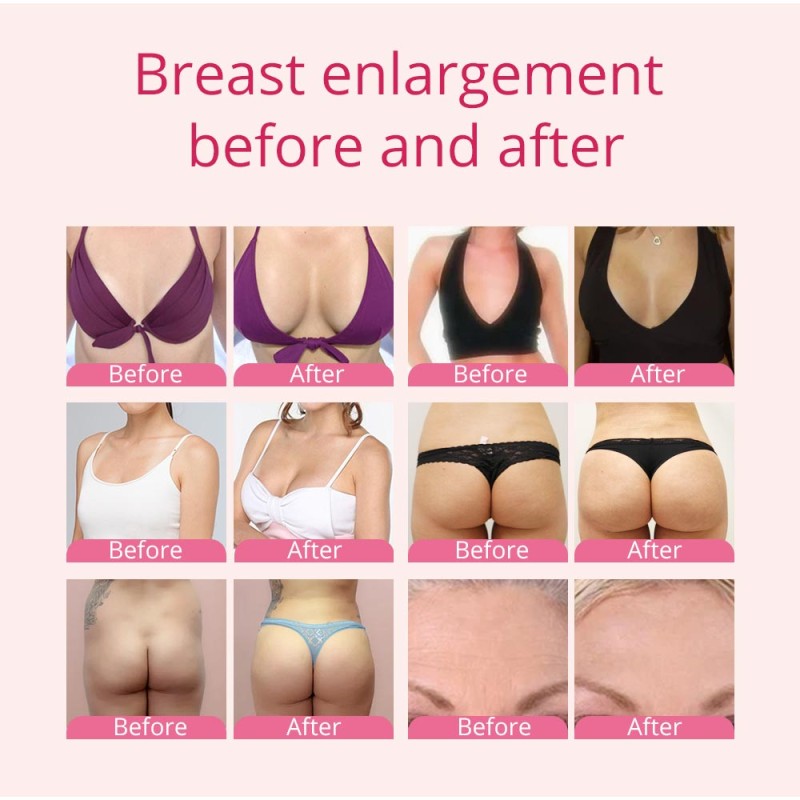 Unique and Highly Effective Vacuum Therapy for Breast Lift